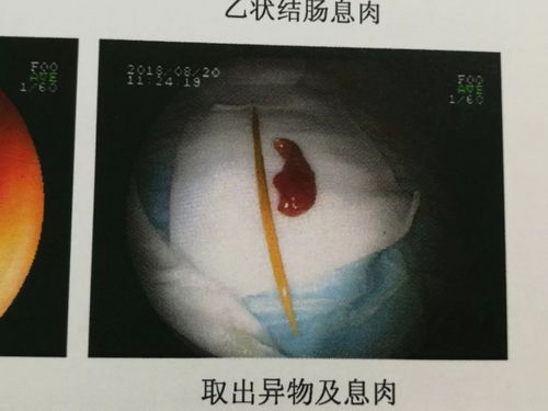 3岁半儿子将牙签放进杯子,爸爸喝水没注意咽了下去