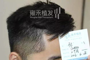 疤痕种植成活率超高发友想要拔掉些社会频道