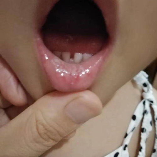 孩子嘴里长了小白点要小心可能是鹅口疮惹的祸