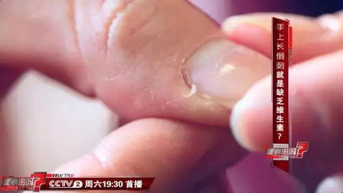 小心成为萝卜指论倒刺的正确处理方法