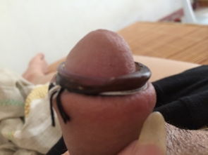 韩式包皮手术,环切手术,那个套是自己掉下来还是去医院拿掉