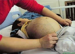 肝炎引起的脾肿大如何治疗呢