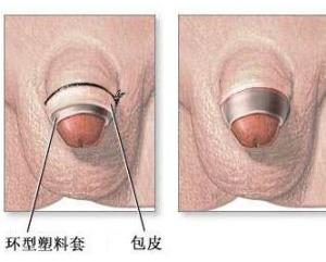 包皮环扎术