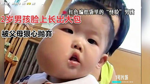 2岁男孩脸上长出大包,被狠心父母装在编织袋里丢弃,看着太心疼