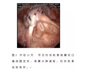 耳鼻咽喉头颈外科颈侧下咽进路超声刀切除成人喉血管瘤1例