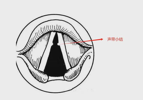 喉咙长了小肉球,是声带息肉小结还是......