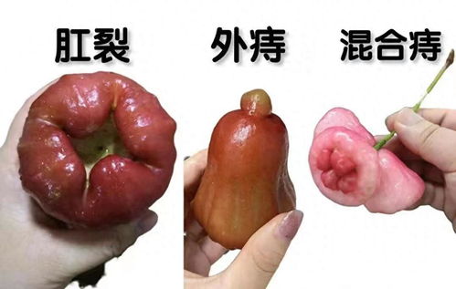 得了痔疮后,迅速备齐这几样东西会好的很快,别怪我没提醒你