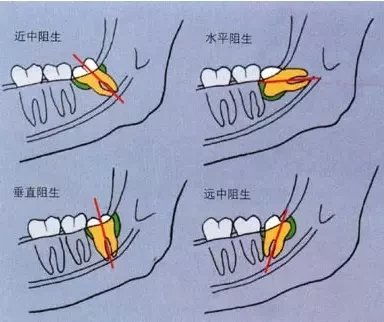 一颗小小智齿姿势千奇百怪,你的智齿长啥样