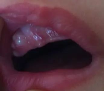孕妈妈少吃这类胃热的食物,可预防宝宝口腔里长出传说的马牙