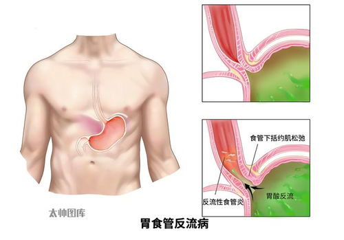 一天几杯续命杭州女子总感觉喉咙被卡住医生提醒