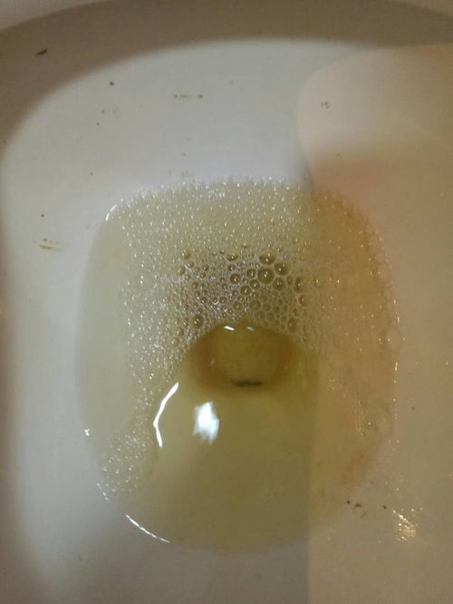 晚上2327,尿里好多泡泡,一分多钟散尽尿常规几乎正常,只有尿比重正常高位求解2型糖尿病甜蜜家园poweredbydiscuz