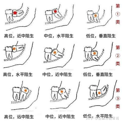 智齿疼的可爱表情包