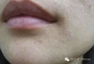 皮肤暗黄还长斑,6大肌肤缺水症状你中招了吗