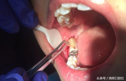 拔牙一周后拆线出血怎么办