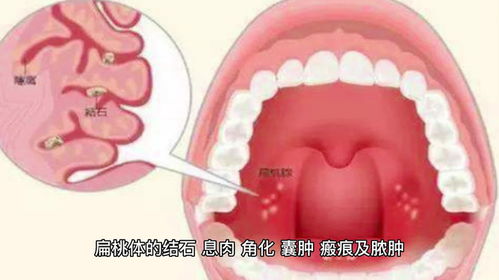 咽喉有异物感该怎么办上海海华医院科普