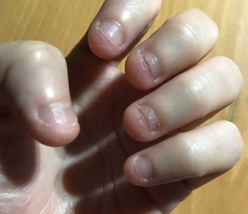 研究发现爱咬指甲的孩子,都逃不过这5种结局