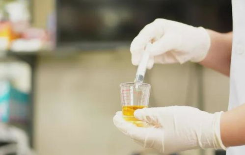 尿液很黄总有泡沫提醒排尿时若有4个变化,可能是大病来袭