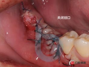 密室里的拔牙阻生牙拔除后的即刻种植邵现红医生