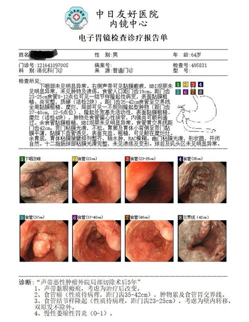 咽喉恶性肿瘤