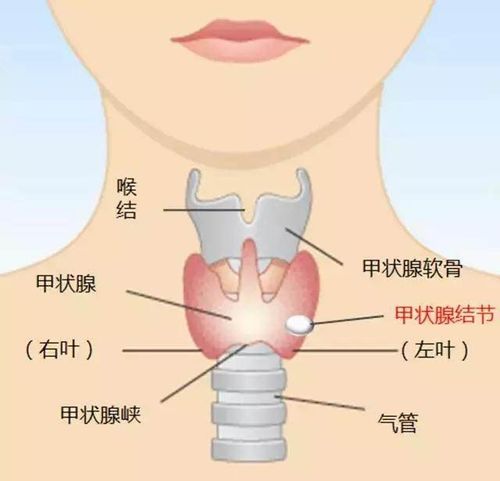 甲状腺癌偏爱女性,缘起何处过度治疗是否会影响生育