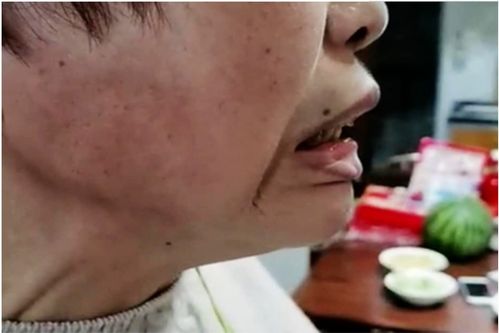 无法控制的咬牙切齿,原来是咬肌痉挛