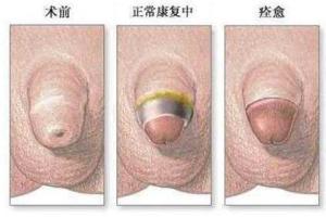 韩式环切包皮手术恢复