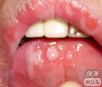 口腔溃疡可以分为哪几种类型口腔溃疡的三种类型