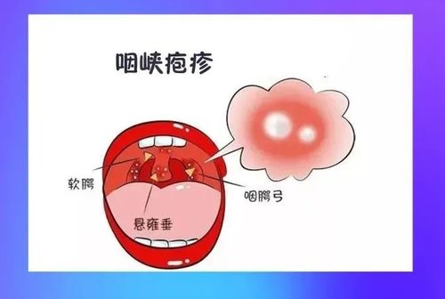 进入高发期唐山疾控最新提醒急性发热咽痛呕吐