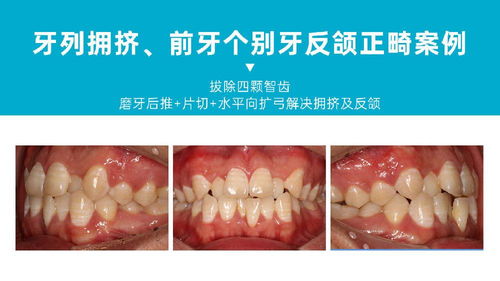 深圳牙套历程分享拔除四颗智齿,磨牙后推片切扩弓解决拥挤及反颌