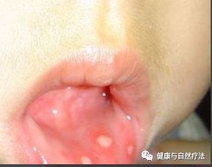 口腔溃疡与消化系统疾病的关联