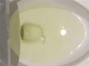 怎样区分正常尿液与异常尿液这些常识你得清楚