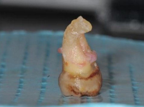 拨智齿后几天能恢复拔牙多长时间以后可以正常吃饭