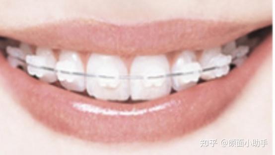 凸嘴该怎么样改善