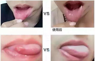 7亿人感染了这种胃癌致病菌