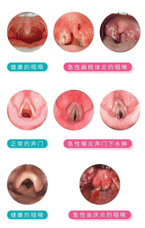 孩子咽喉不适,90是因为这个,别急着吃药