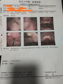 今天查出喉咙里长了个肿瘤结果已出,颗粒细胞瘤