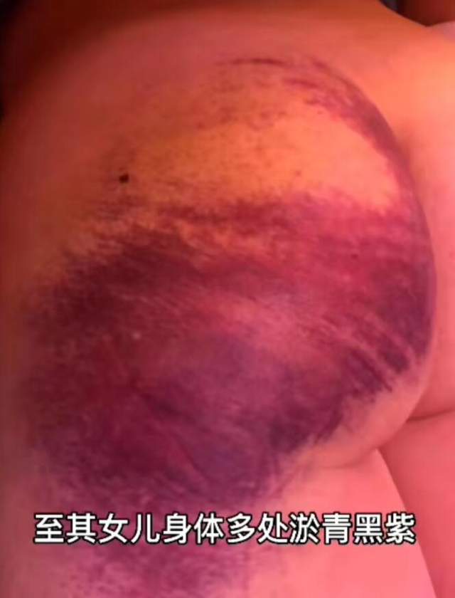 南阳一学校体罚学生打到身体多处淤青黑紫,此事例在该校非首次