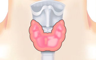 甲状腺癌概述