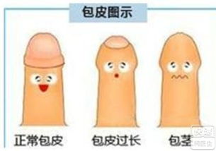 杭州做包茎包皮手术费用是多少