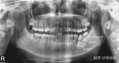 25岁后去矫正牙齿戴牙套是什么体验